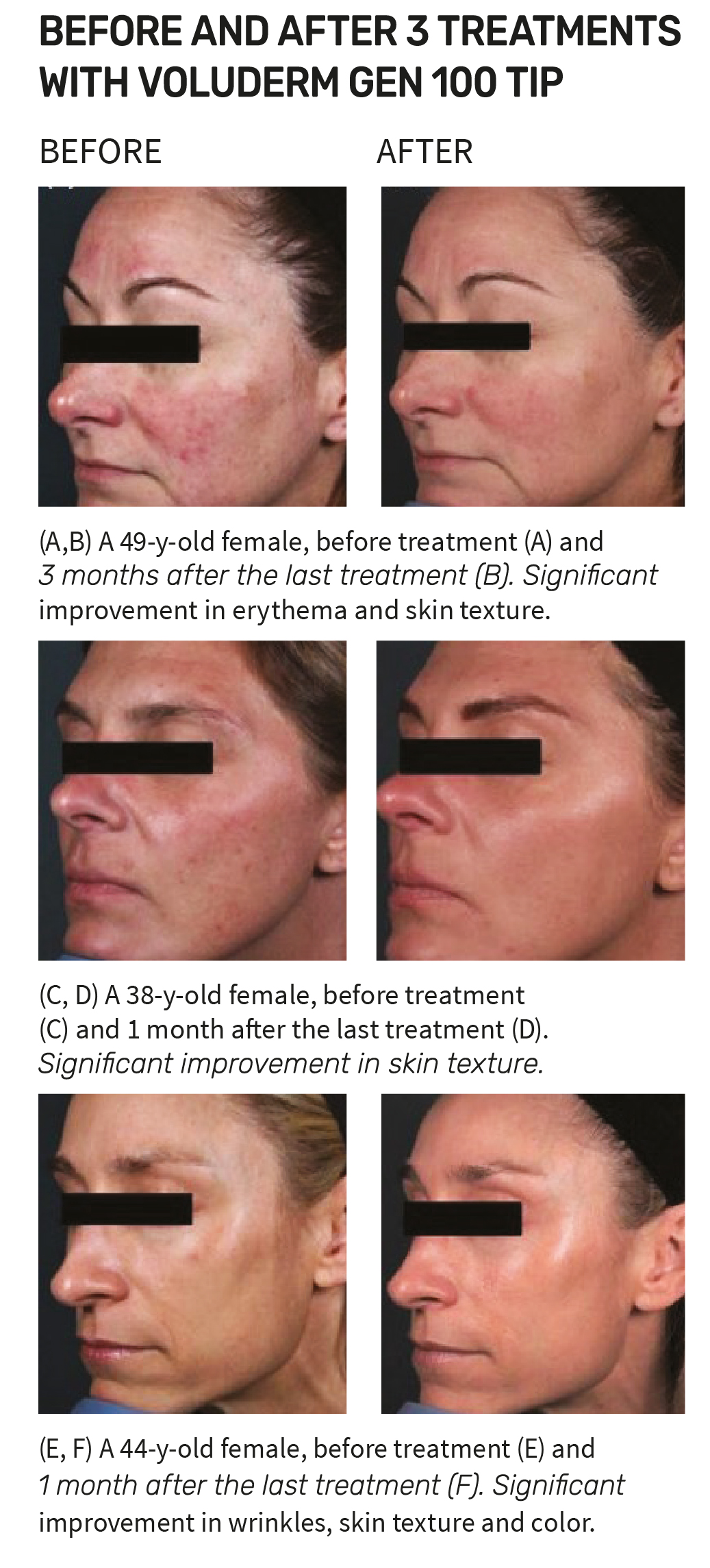 Complete Skin Rejuvenation before and after